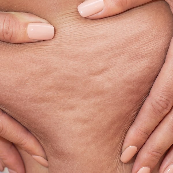 cellulite